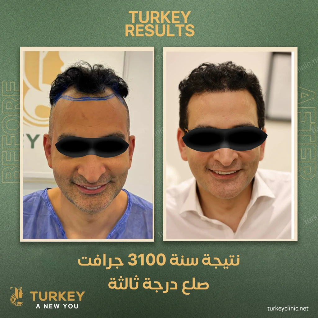 افضل مركز زراعة الشعر في مصر 5 نتيجة زراعة 3100 جرافت بعد مررور سنة من الزراعة