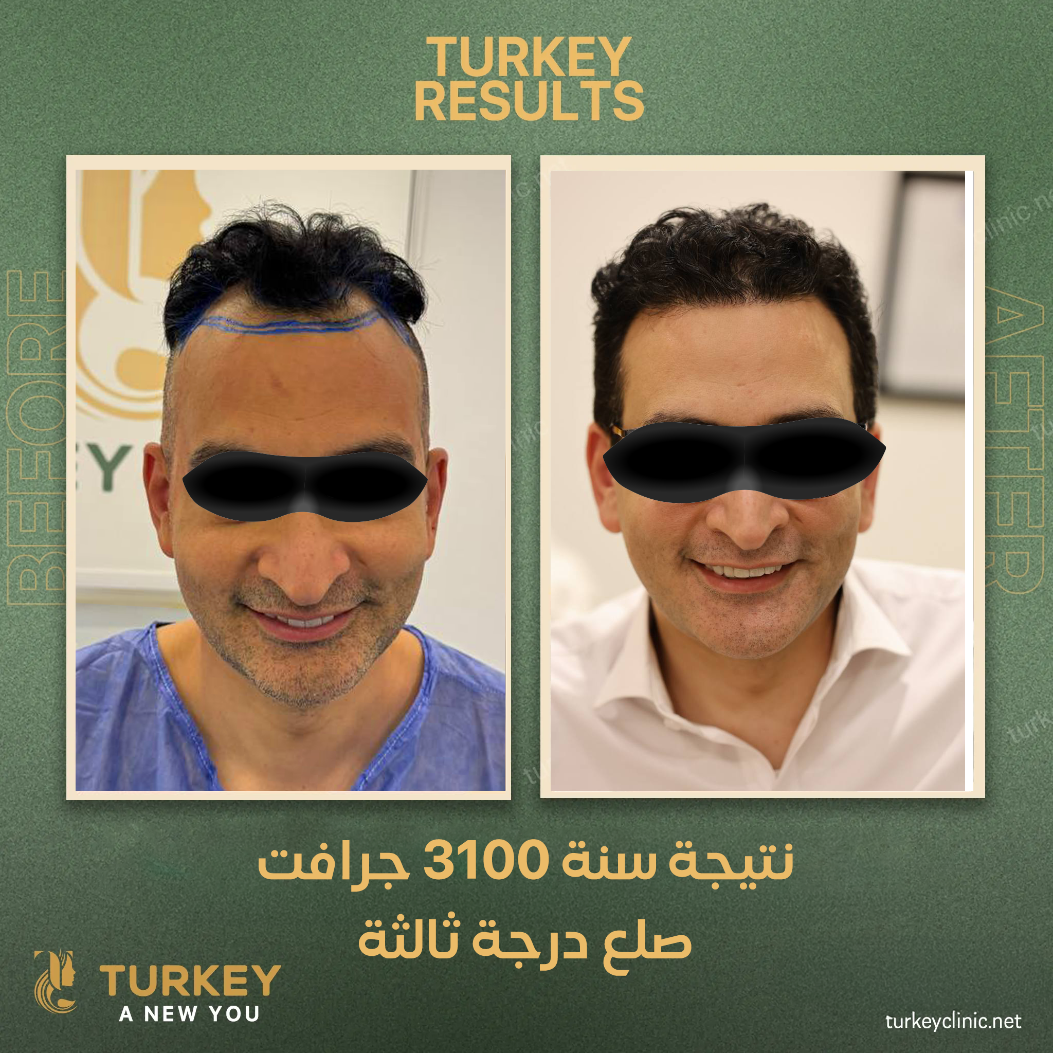 نتيجة زراعة 3100 جرافت بعد مررور سنة من الزراعة