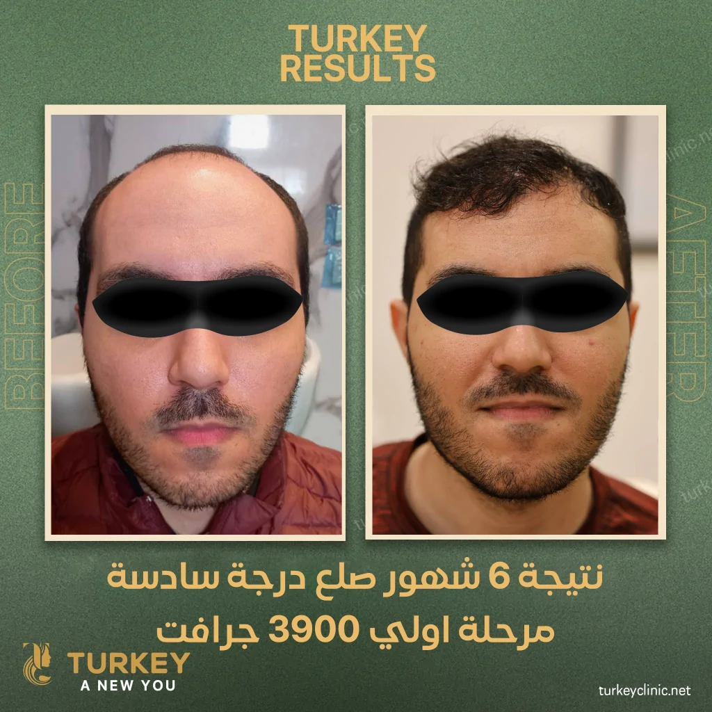 افضل مركز زراعة الشعر في مصر 7 نتيجة زراعة 3900 جرافت بعد 6 شهور من الزراعة