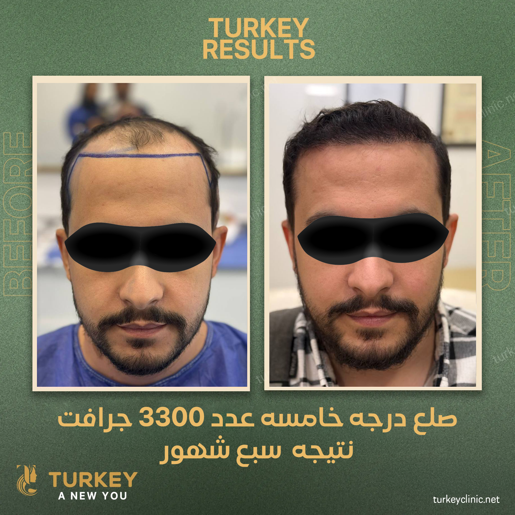 نتيجة زراعة الشعر بعد 7 شهور