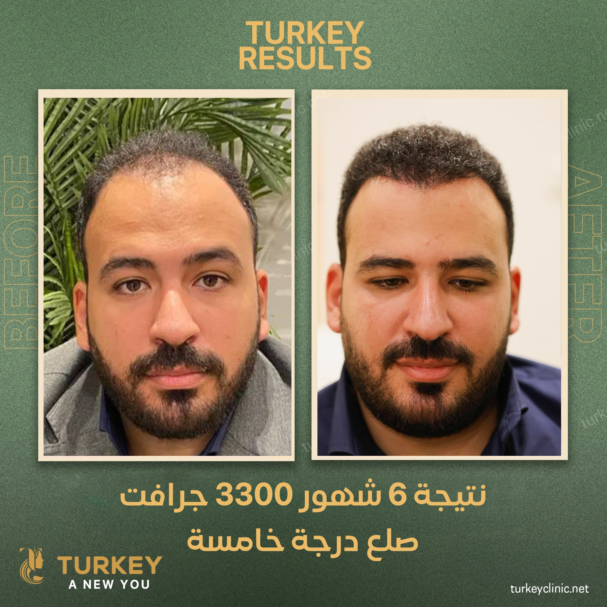 نتيجة زراعة شعر بعد 6 شهور 1