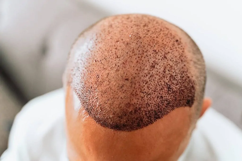 هل زراعة الشعر تسبب السرطان أم أنها خرافة طبية؟ 3 هل زراعة الشعر تسبب السرطان