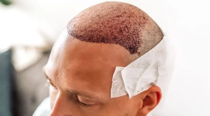 هل زراعة الشعر تسبب السرطان