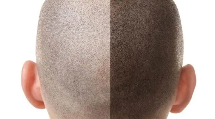 الشعر المزروع خفيف