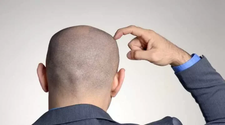 سقوط الشعر المزروع مع القشر