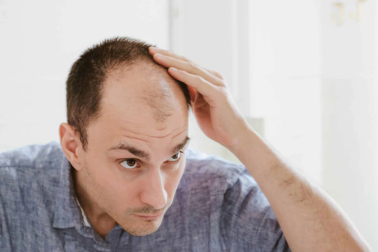 علاج الصلع عند الرجال