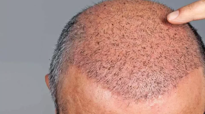 لمس الشعر المزروع