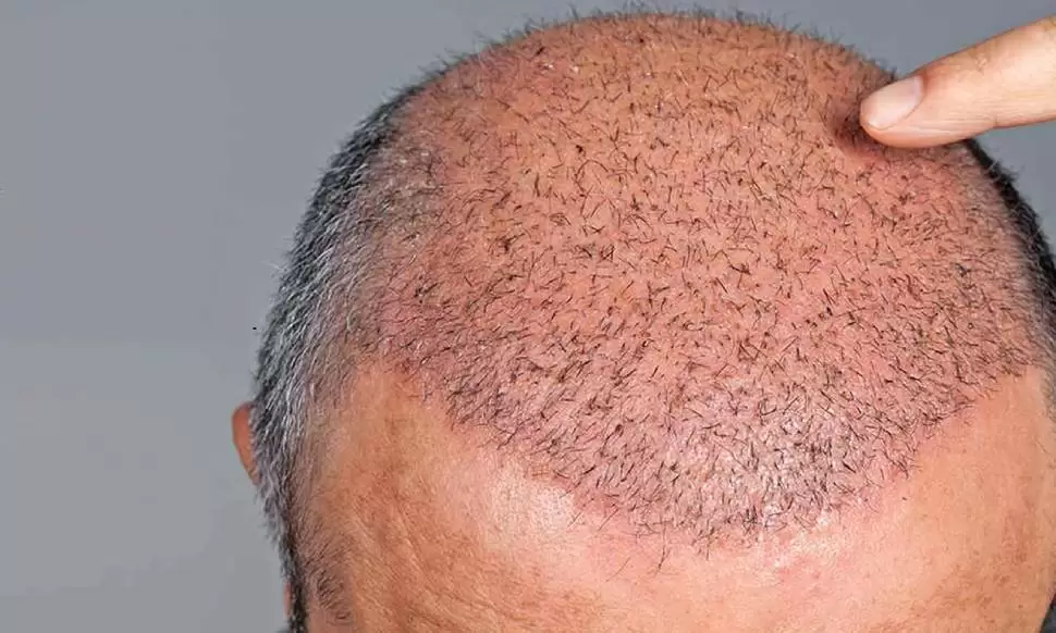 لمس الشعر المزروع