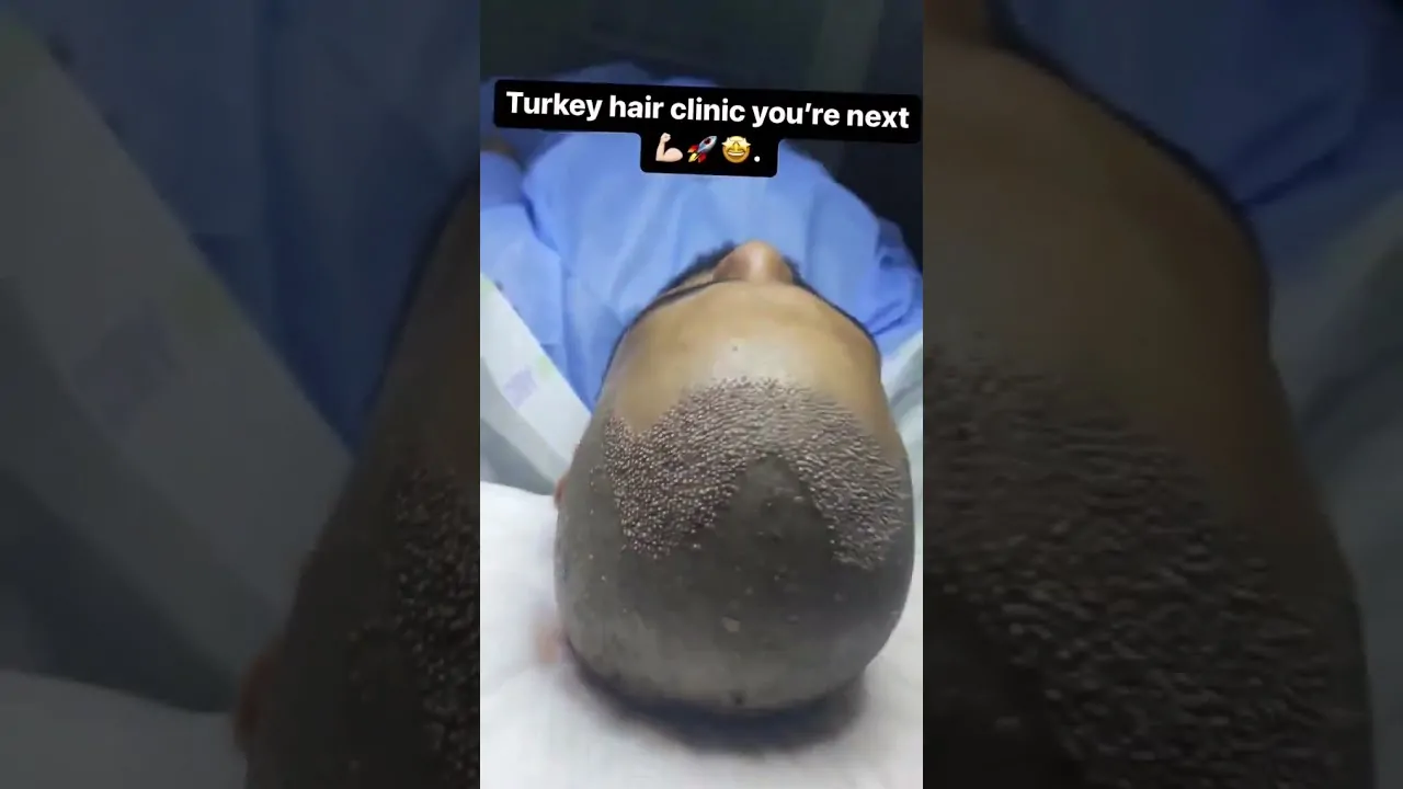 ما بعد عملية زراعة الشعر