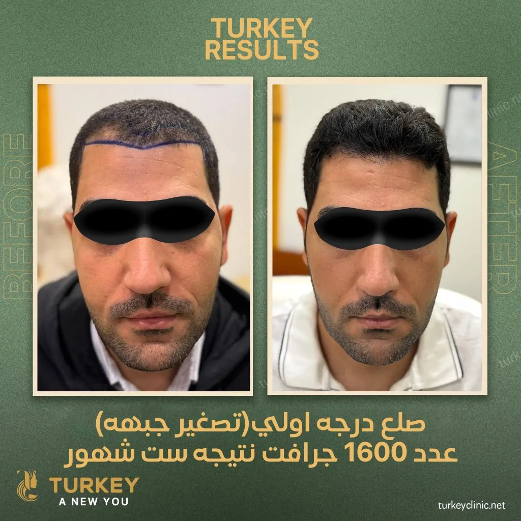 تكلفة زراعة خط الشعر الامامي 2025 4 نتيجة تصغير الجبهة بالزراعة لصلع درجة اولى