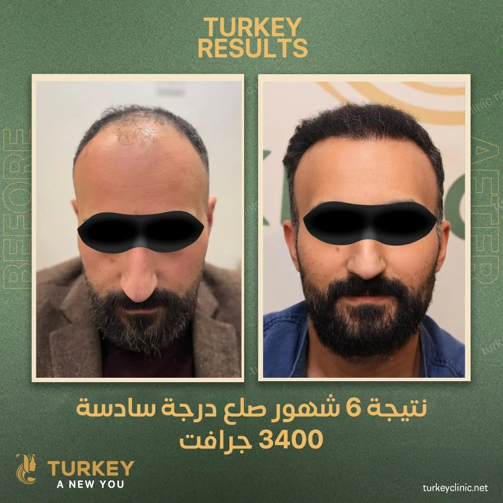 نتيجة زراعة 3400 جرافت بعد 6 شهور