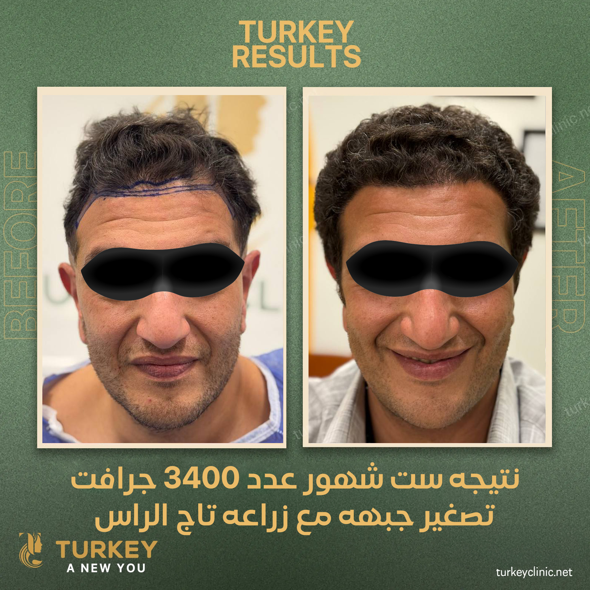 نتيجة زراعة شعر بعد 6 شهور وزراعة 3400 جرافت