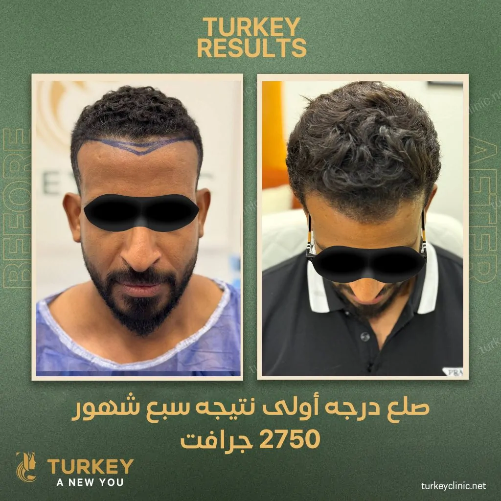 نتيجة زراعة شعر لصلع درجة أولى بعد سبع شهور