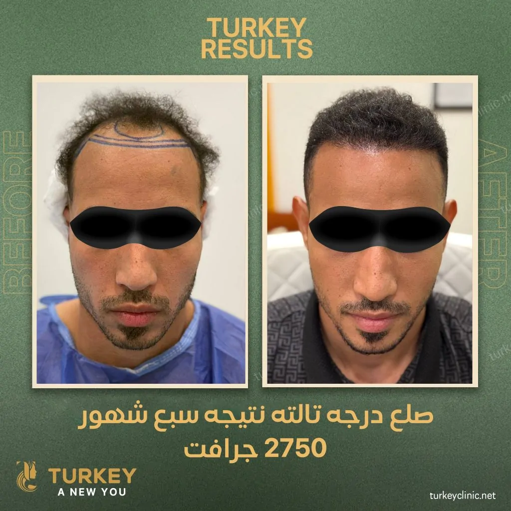 نتيجة زراعة2750 جرافت بعد سبع شهور