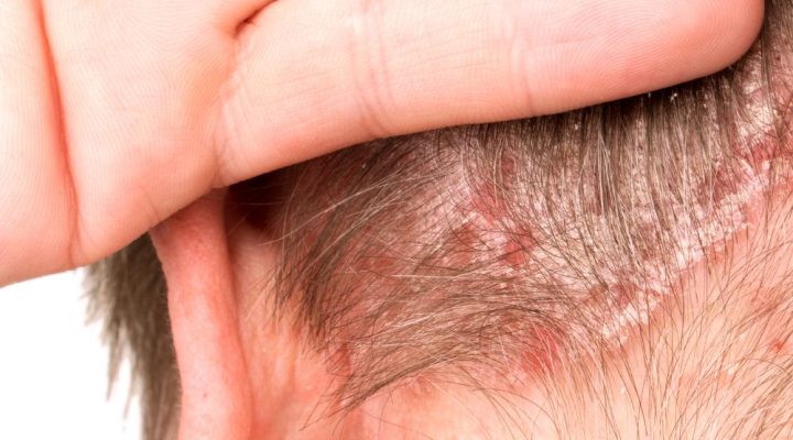 الحبوب بعد عملية زراعة الشعر