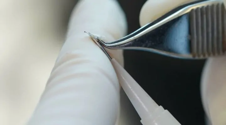 أفضل تقنية لزراعة الشعر