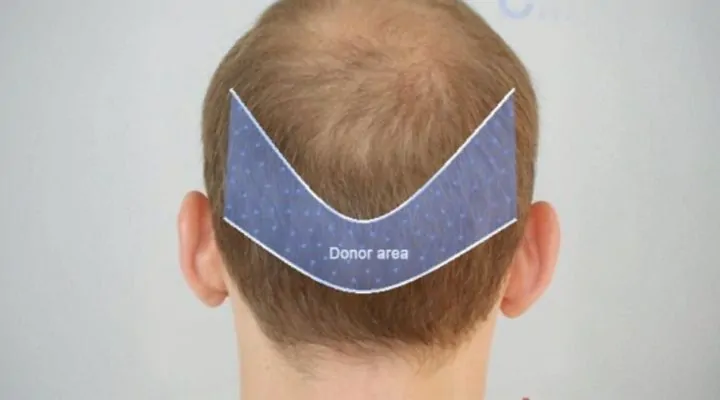 المنطقة المانحة بعد شهرين