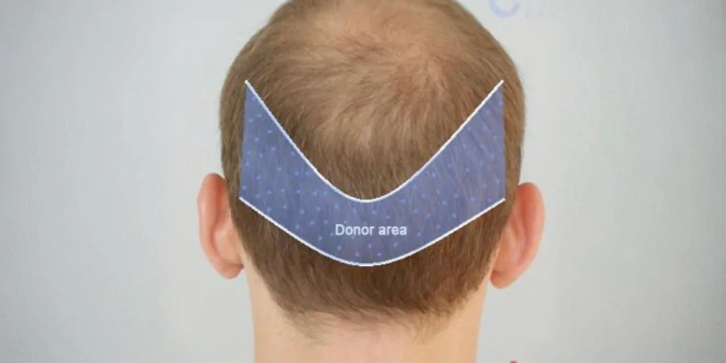 المنطقة المانحة بعد شهرين