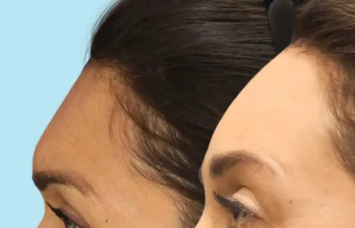 شاهد تجربتي مع عملية تصغير الجبهة الناجحة في مركز تركي كلينك 2 تجربتي مع عملية تصغير الجبهة