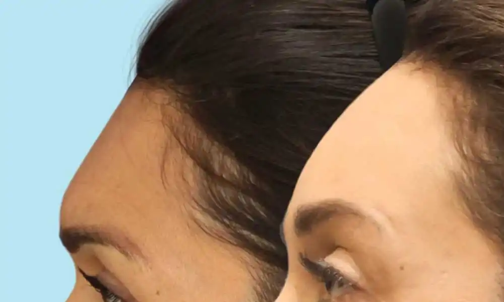 تجربتي مع عملية تصغير الجبهة