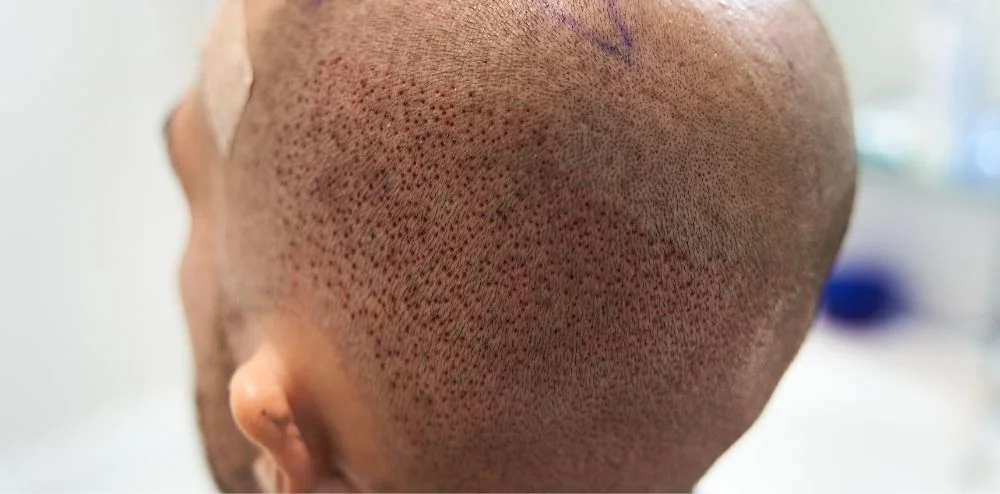 زراعة الشعر في أماكن الجروح مجربة | شاهد نتائج تركي كلينك 3 تقنية البيركوتان لزراعة الشعر