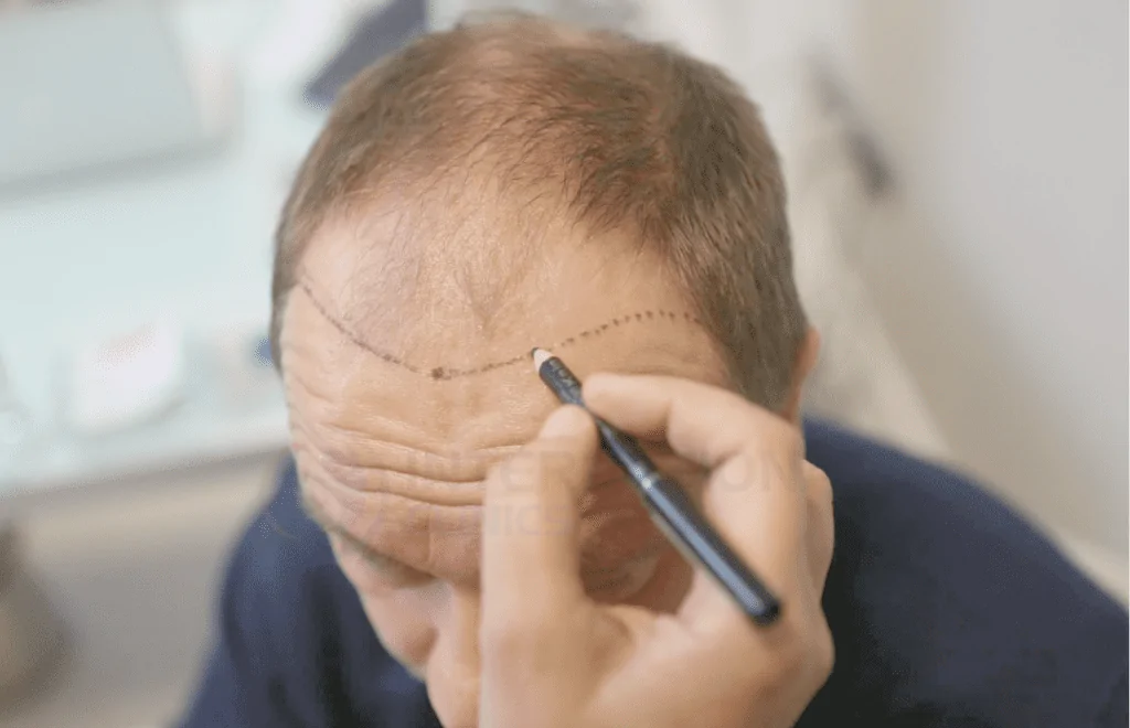 زراعة الشعر في أماكن الجروح مجربة | شاهد نتائج تركي كلينك 5 تكلفة زراعة الشعر في أماكن الجروح