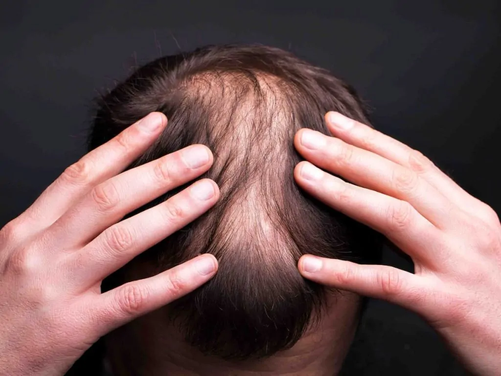 تجارب زراعة الشعر للمرة الثانية بالصور 2 زراعة الشعر للمرة الثانية