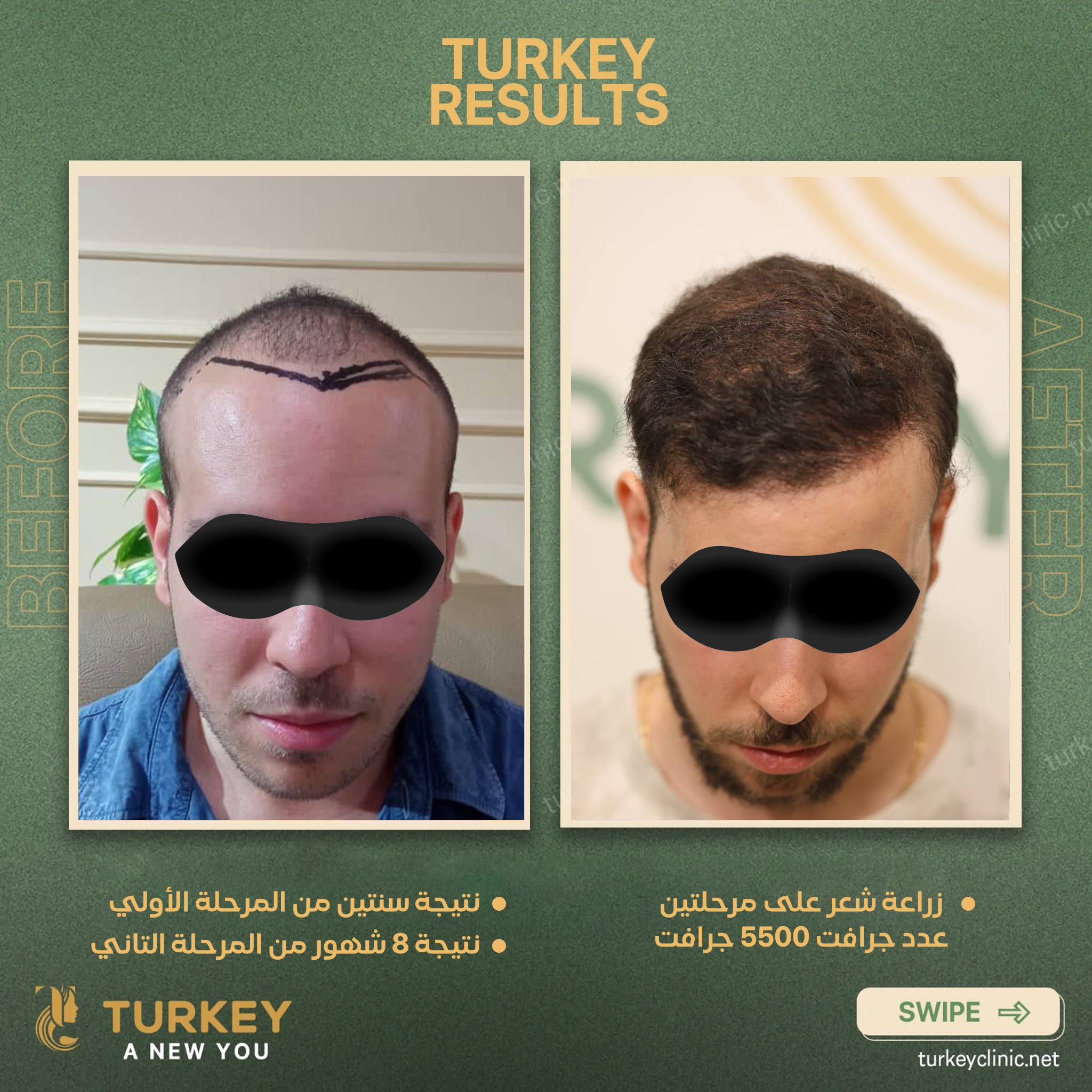 زراعة شعر على مرحلتين عدد 5500 جرافت نتيجة سنتين مرحلة أولي ونتيجة 8 شهور مرحلة تانية