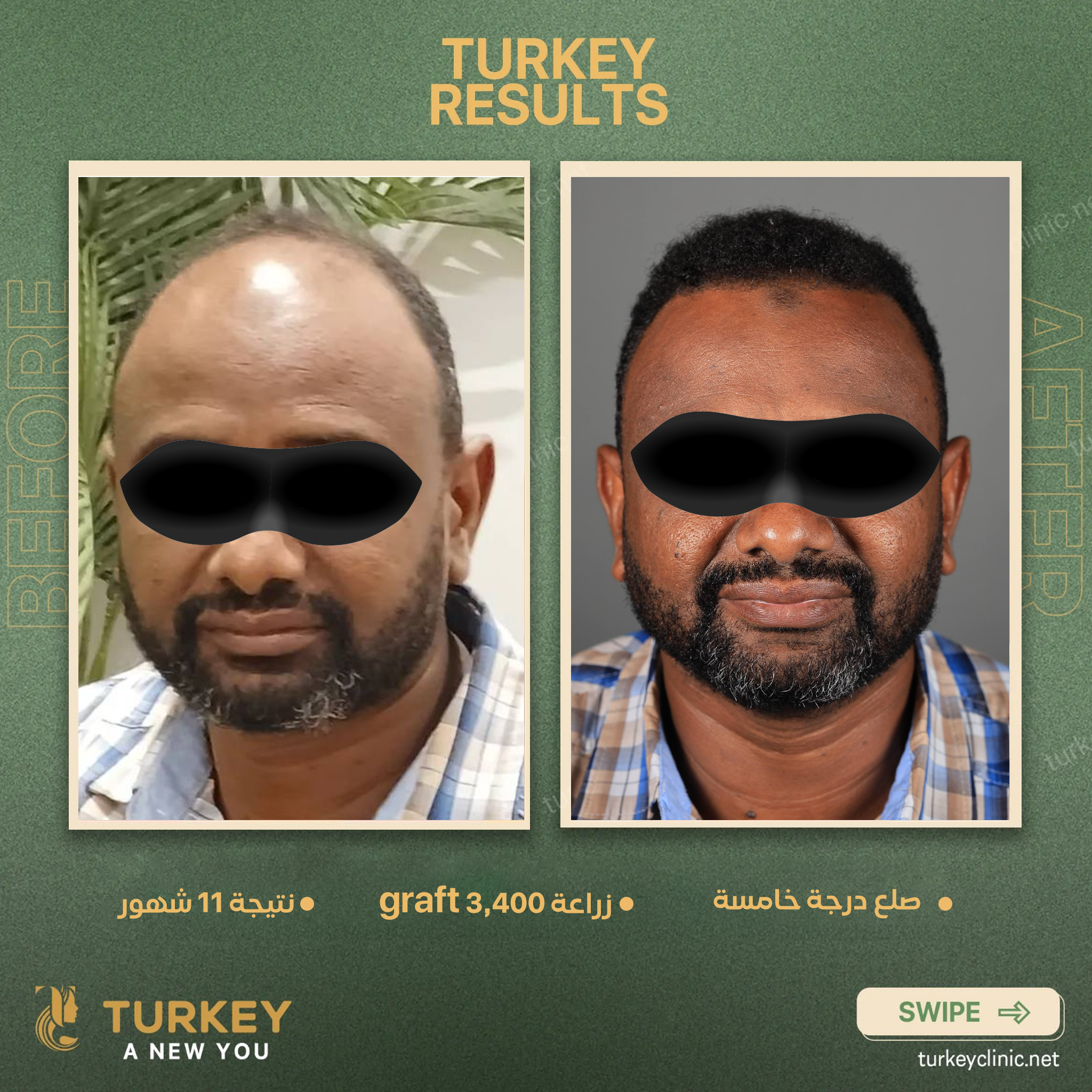 صلع درجة خامسة زراعة 3400 جرافت نتيجة 11 شهر