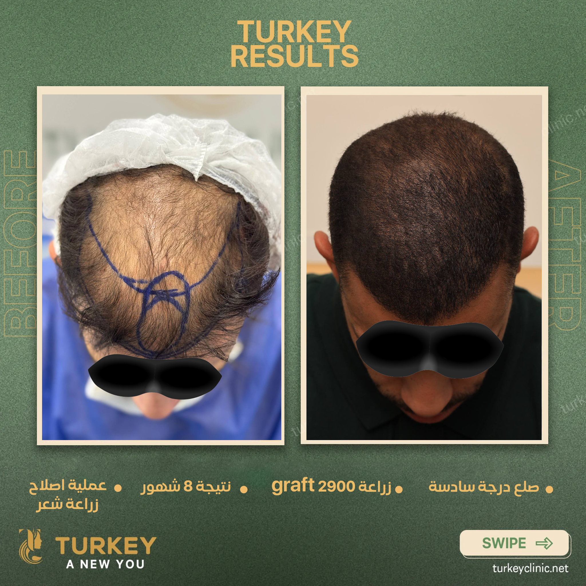 صلع درجة سادسة زراعة 2900 جرافت نتيجة 8 شهور عملية اصلاح زراعة شعر