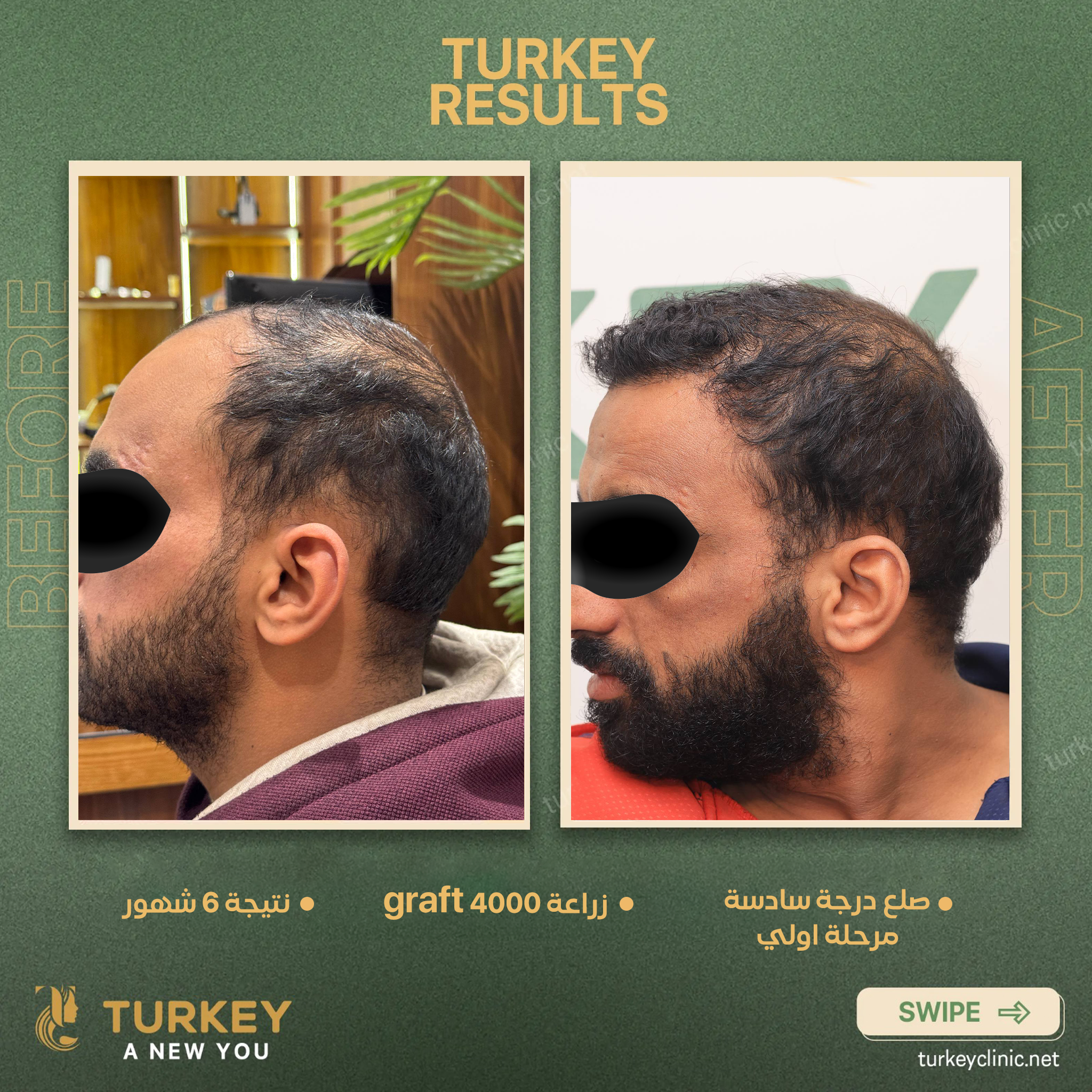 صلع درجة سادسة مرحلة اولي زراعة 4000 جرافت نتيجة 6شهور