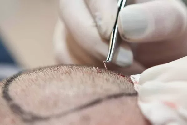 مخاطر الإفراط في استخراج البصيلات