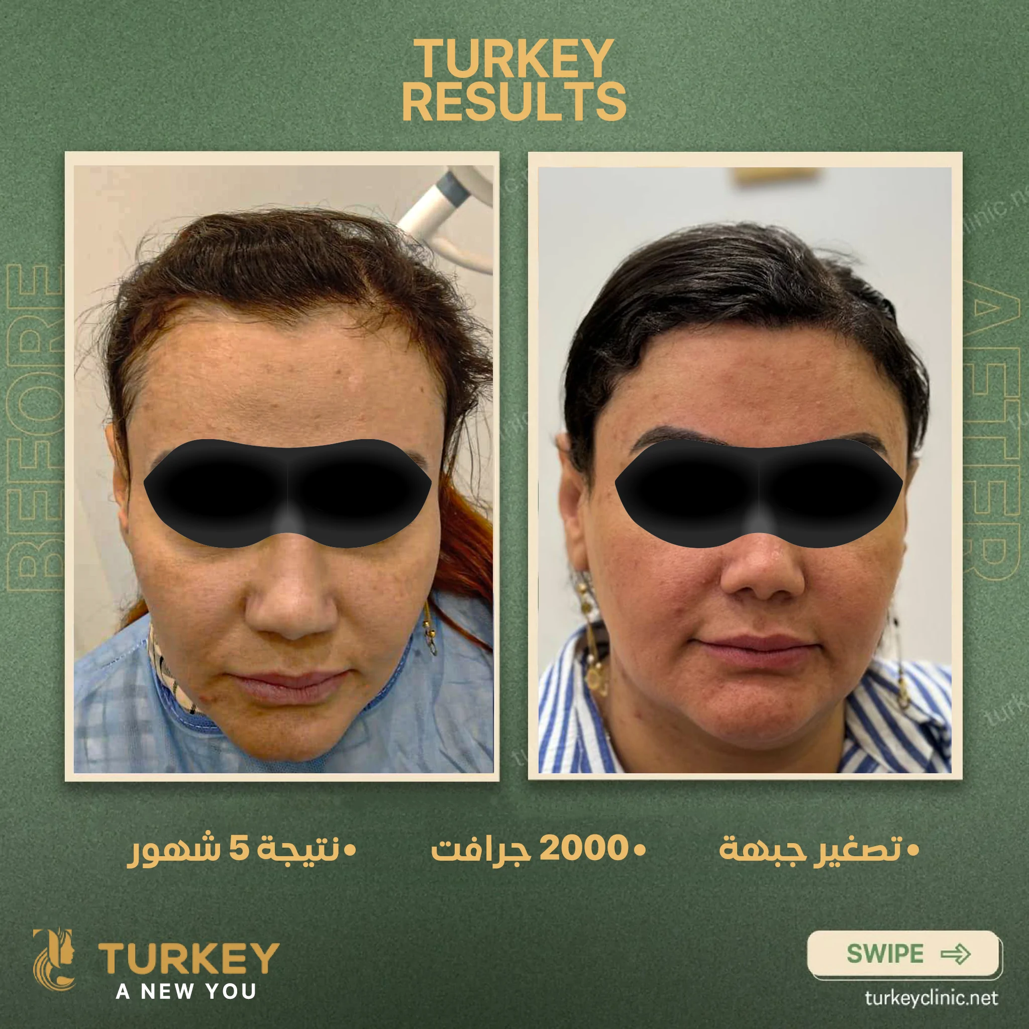 زراعة الشعر في سن الثلاثين | هل الوقت مناسب؟ 12 تصغير جبهة 2000 جرافت نتيجة 5 شهور