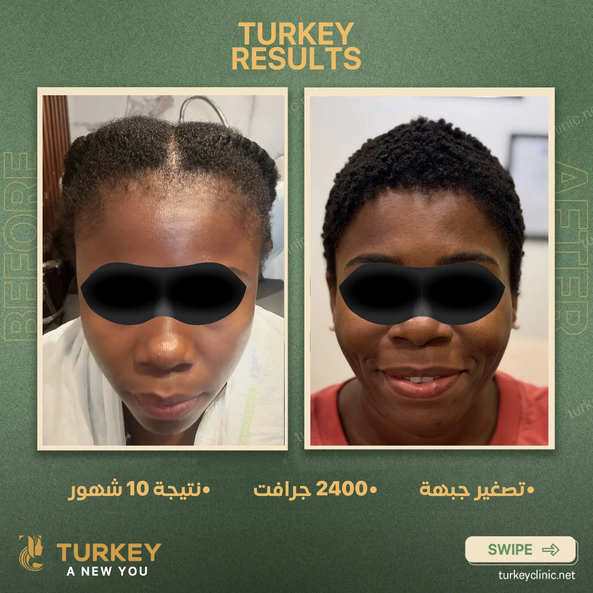 زراعة الشعر في سن الثلاثين | هل الوقت مناسب؟ 13 تصغير جبهة 2400 جرافت نتيجة 10 شهور