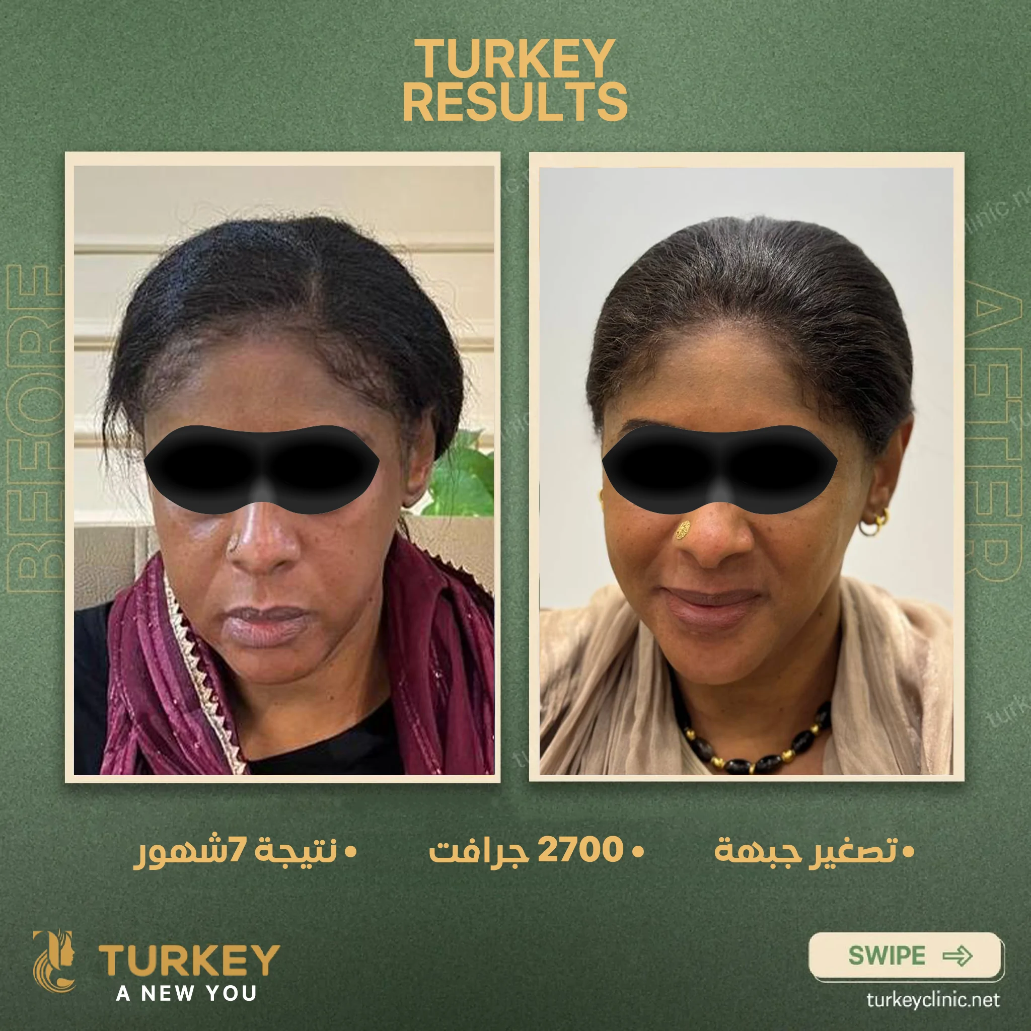 زراعة الشعر في سن الثلاثين | هل الوقت مناسب؟ 11 تصغير جبهة 2700 جرافت نتيجة 7شهور