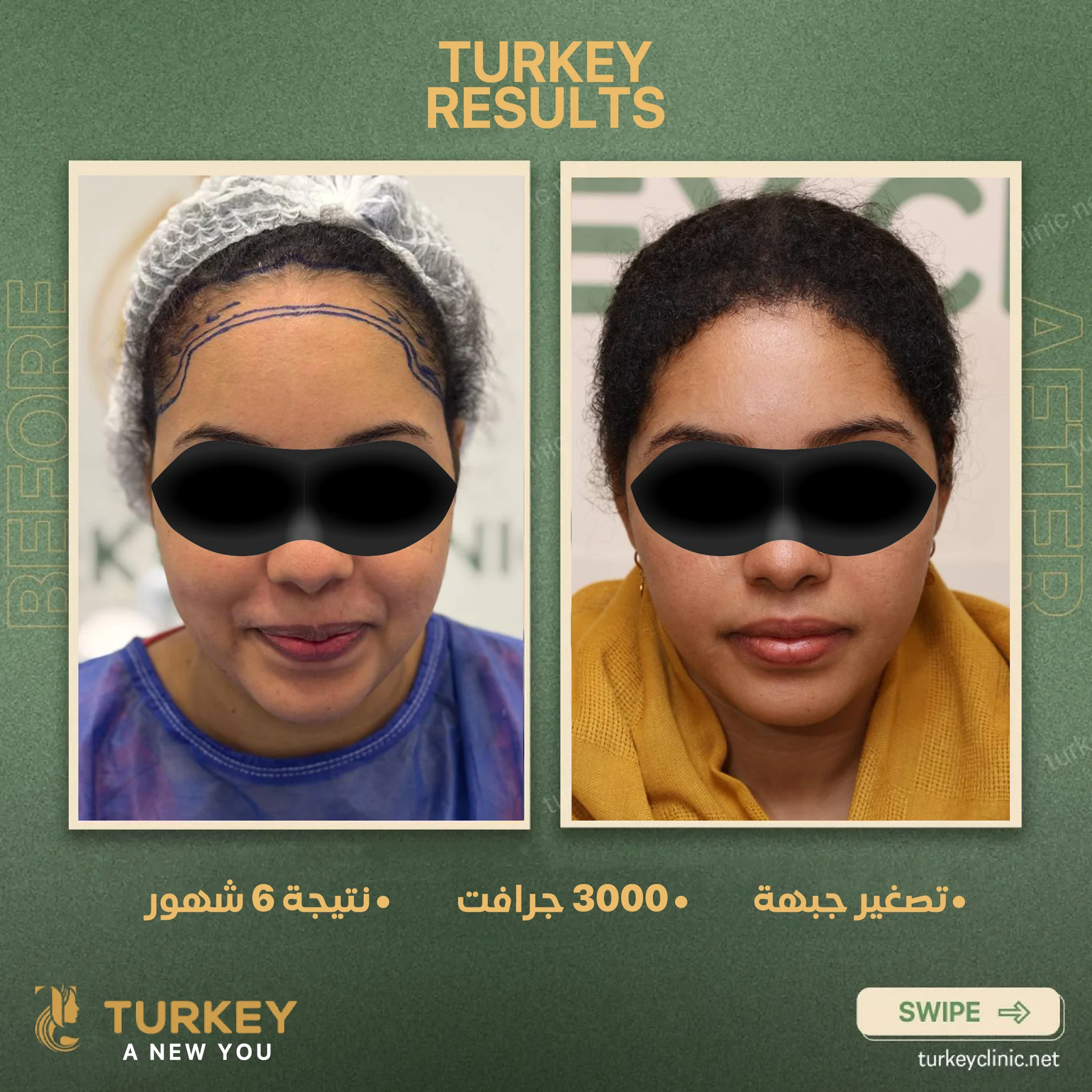 زراعة الشعر في سن الثلاثين | هل الوقت مناسب؟ 10 تصغير جبهة 3000 جرافت نتيجة 6 شهور