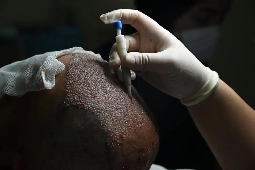 زراعة الشعر في سن الثلاثين | هل الوقت مناسب؟ 4 تقنية زراعة الشعر DHI