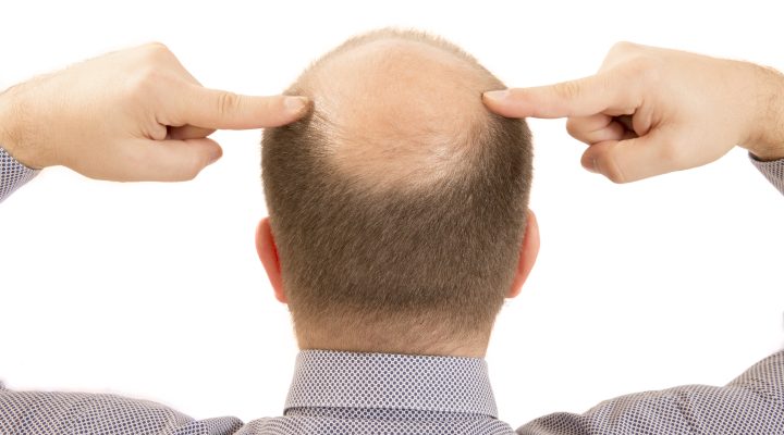 زراعة الشعر لعلاج الصلع
