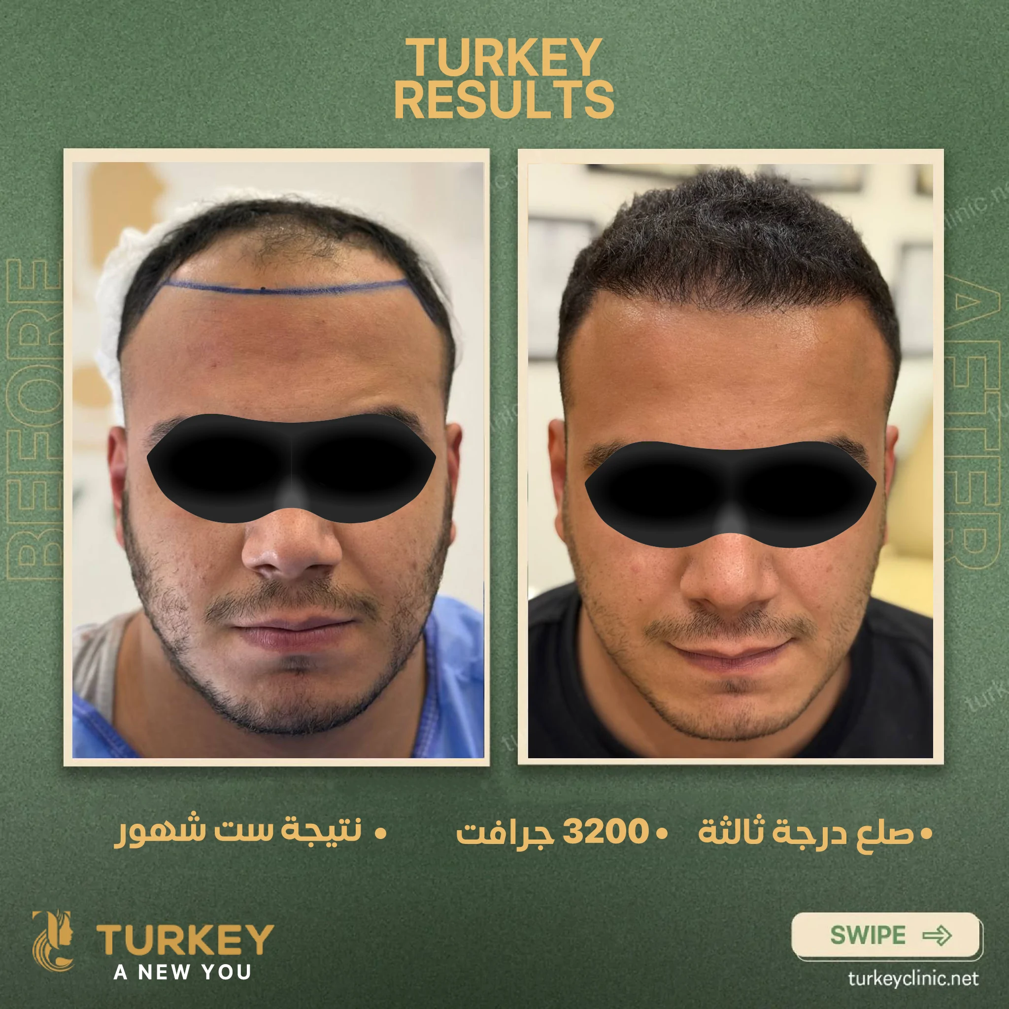 زراعة الشعر في سن الثلاثين | هل الوقت مناسب؟ 5 صلع درجة ثالثة 3200 جرافت نتيجة 6 شهور