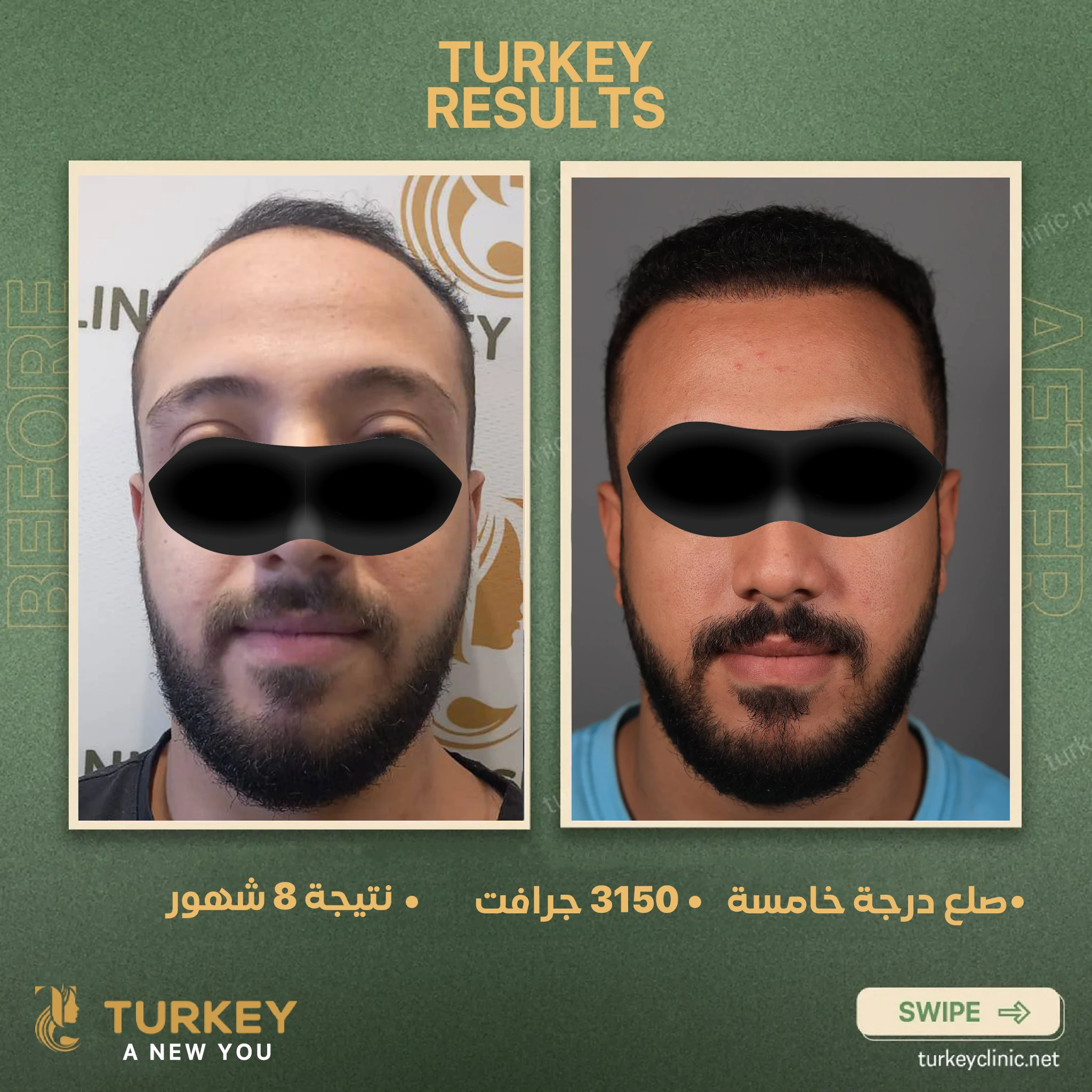 زراعة الشعر في سن الثلاثين | هل الوقت مناسب؟ 8 صلع درجة خامسة 3150 جرافت نتيجة 8 شهور