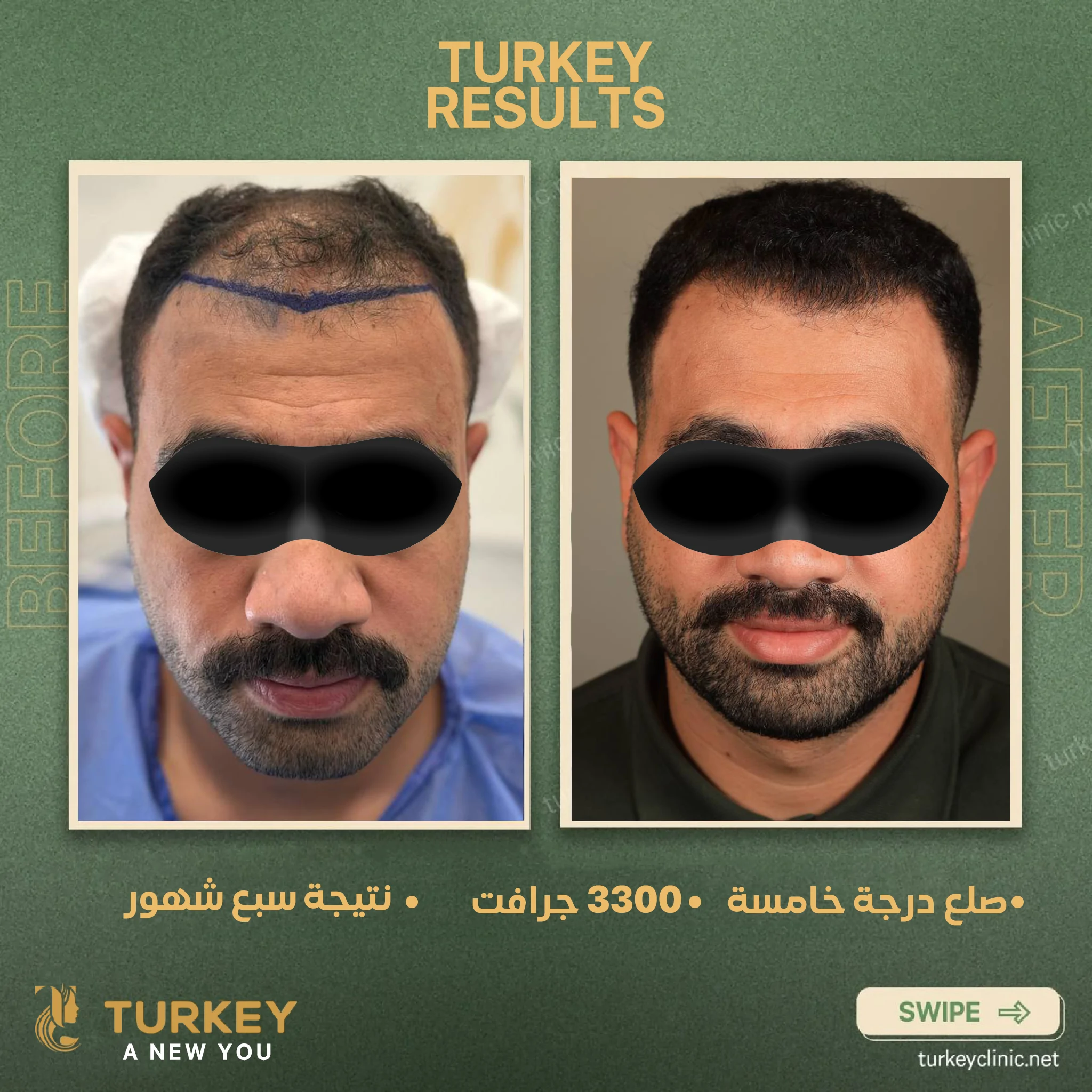 زراعة الشعر في سن الثلاثين | هل الوقت مناسب؟ 6 صلع درجة خامسة 3300 جرافت نتيجة سبع شهور