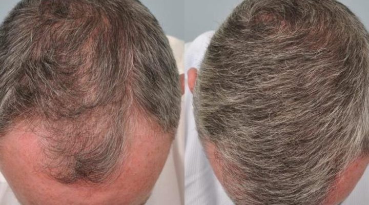 كم سنة تدوم زراعة الشعر