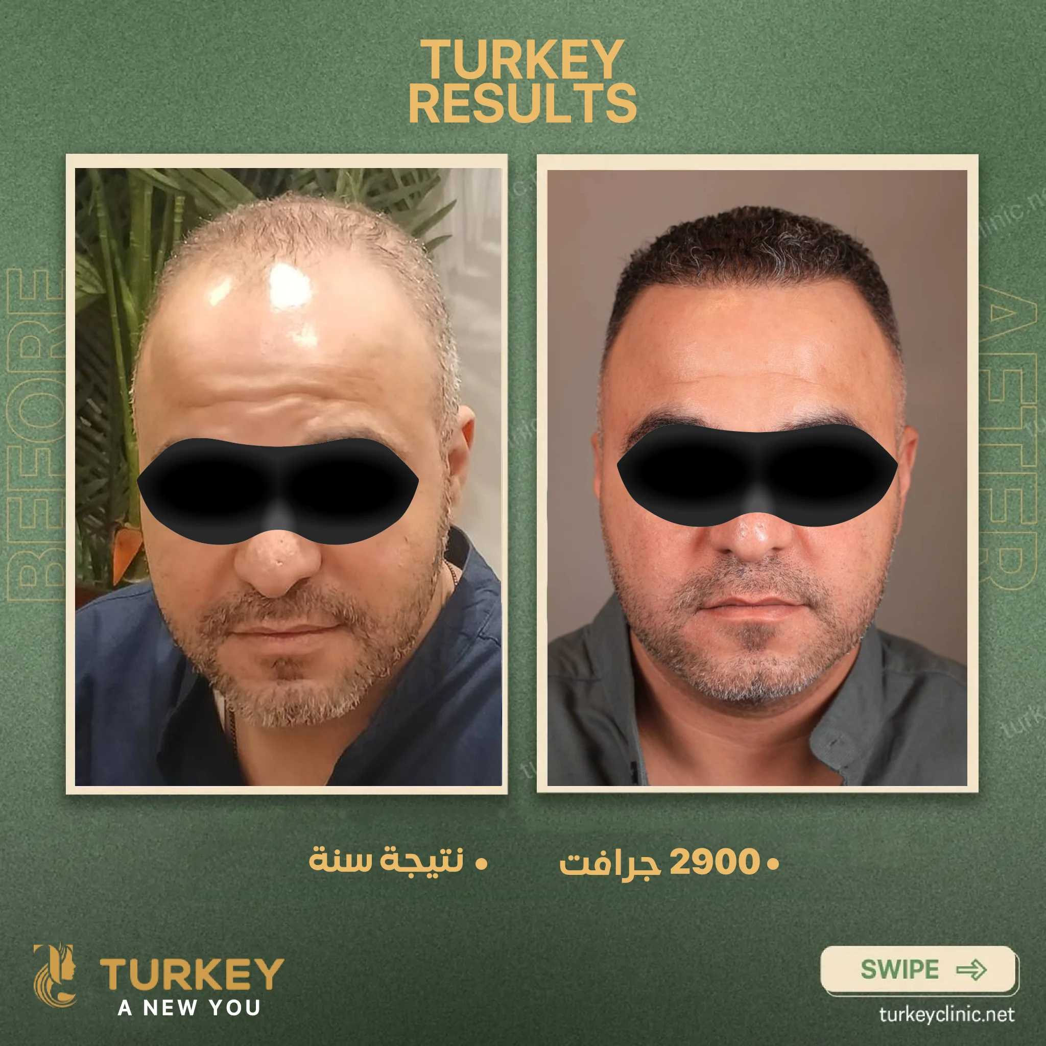 زراعة الشعر في سن الثلاثين | هل الوقت مناسب؟ 7 نتيجة سنة 2900 جرافت