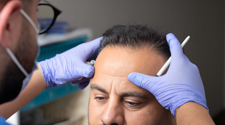 الشعر الطبيعي والشعر المزروع