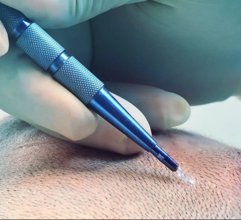 الفرق بين تقنية السفير وتقنية dhi في تركي كلينك 3 ما هي تقنية السفير لزراعة الشعر؟