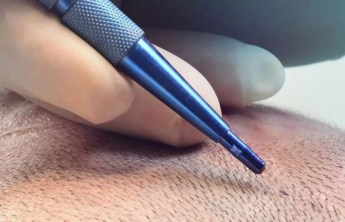 الفرق بين تقنية السفير وتقنية dhi في تركي كلينك 4 ما هي أقلام تشوي (DHI) لزراعة الشعر؟