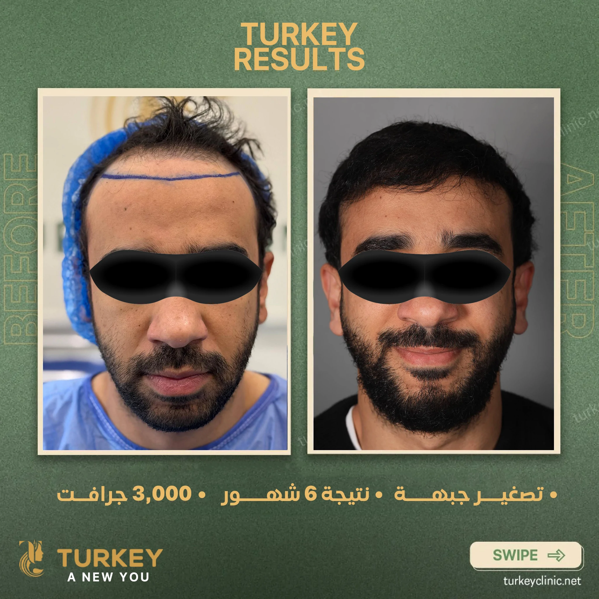 بعد ٢٠ يوم من زراعة الشعر | التغيرات المتوقعة وأهم التعليمات 6 تصغير جبهه نتيجة 6شهور 3000 جرافت