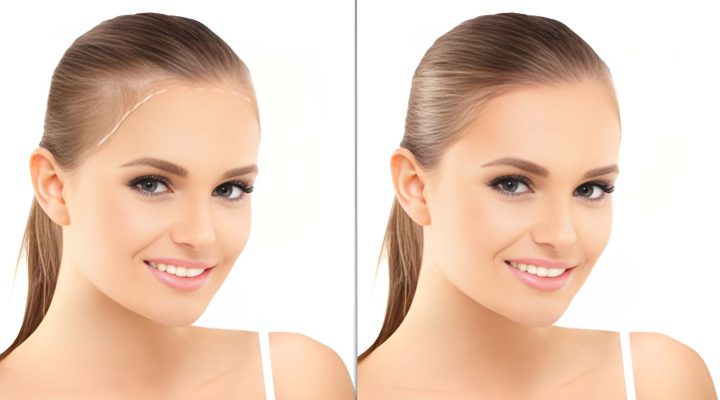 زراعة الشعر في مصر للسيدات