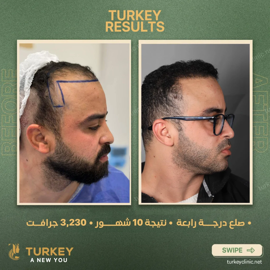 فراغات الشعر من الجوانب للرجال: الأسباب والحلول النهائية 4 صلع درجة رابعة نتيجة 10شهور 3200 جرافت