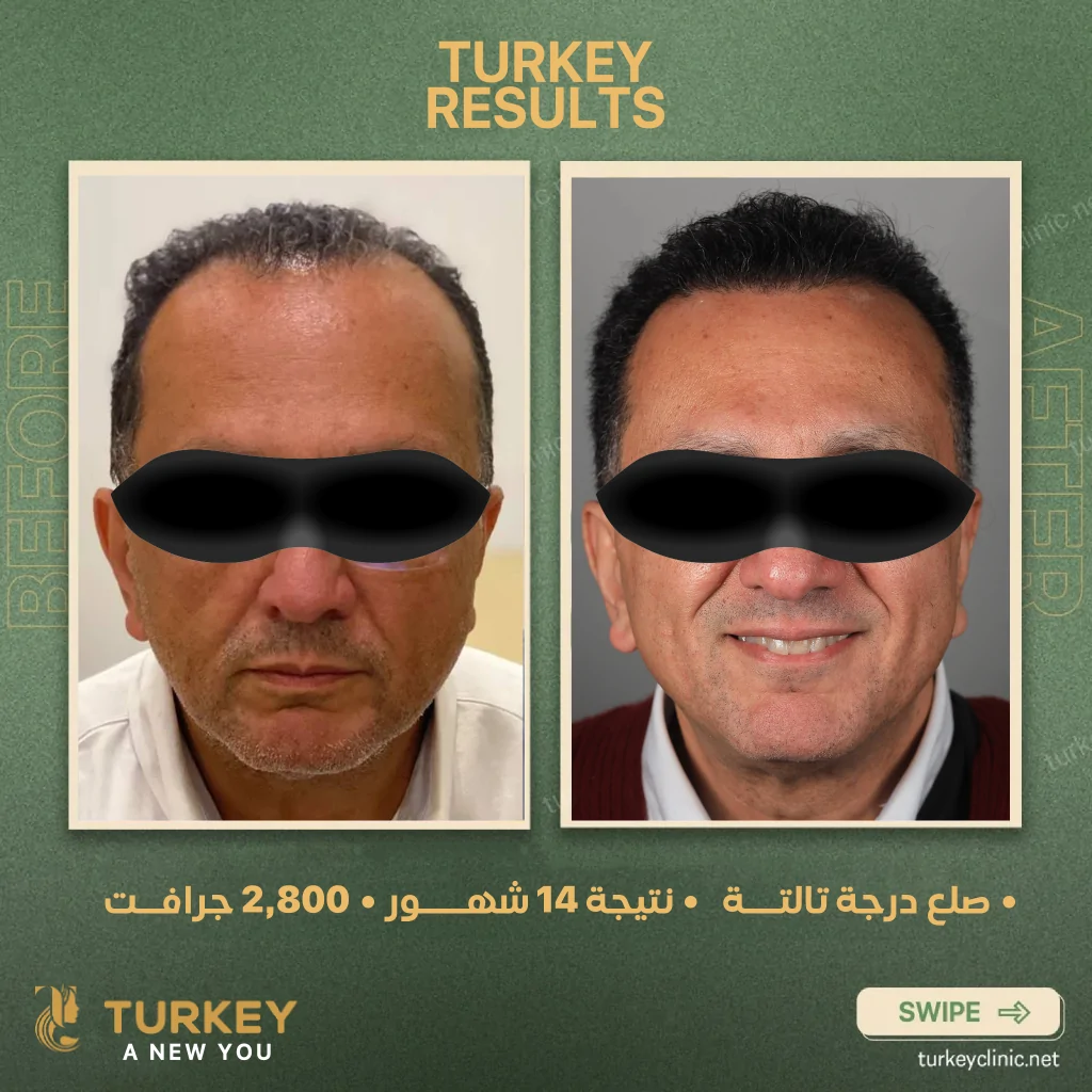 أفضل دكتور زراعة شعر في مصر 2026 - مركز تركي هير 14 صلع درجة رابعة نتيجة 14 شهر 2800 جرافت